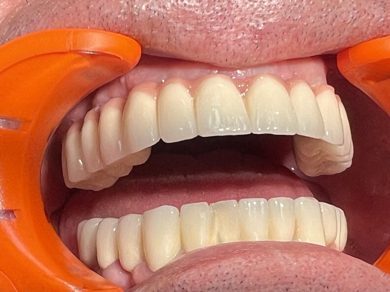 Impianti Dentali in Albania