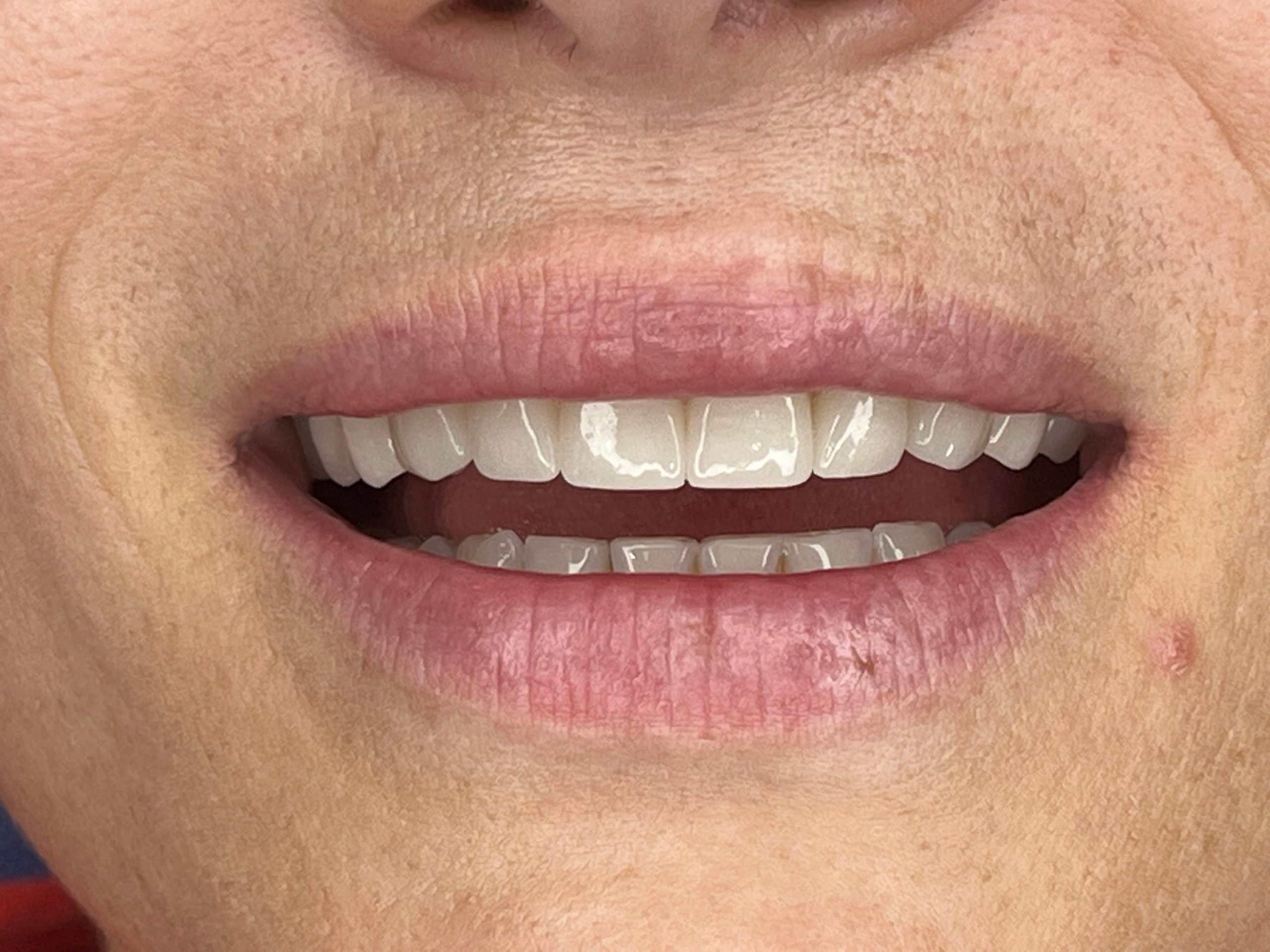 faccette dentali costo Albania