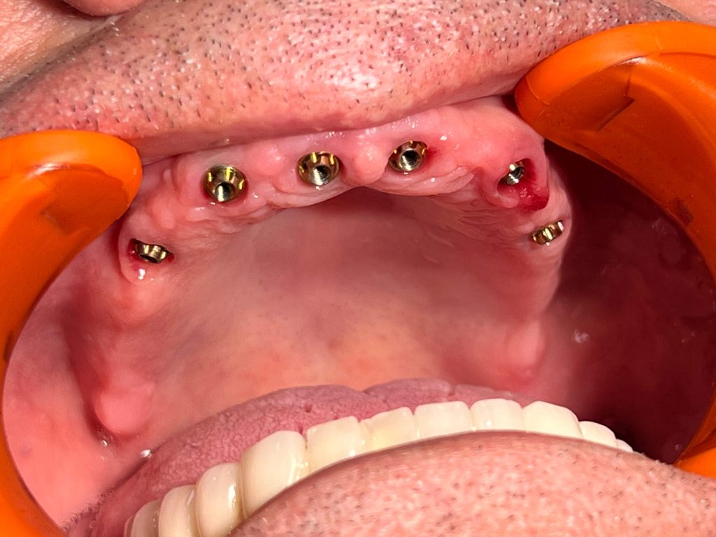 impianti dentali Albania