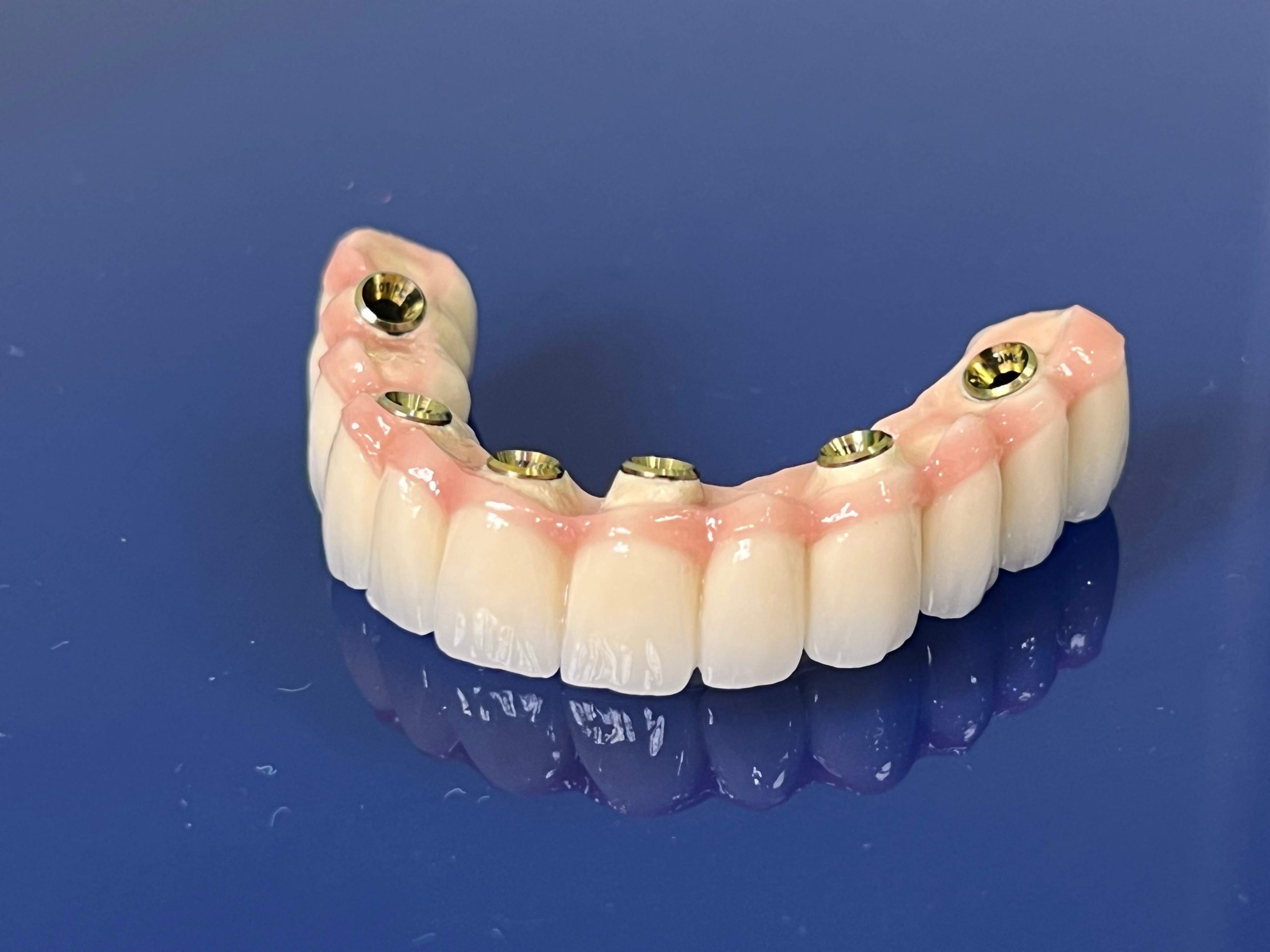 Vantaggi delle Protesi Fisse in Albania