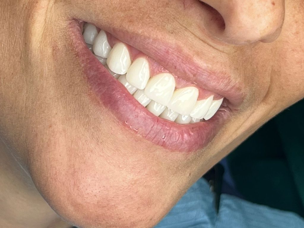 corone dentali in zirconio