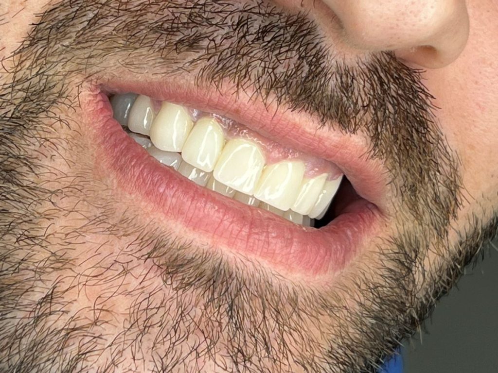 impianti dentali albania prezzi bassissimi