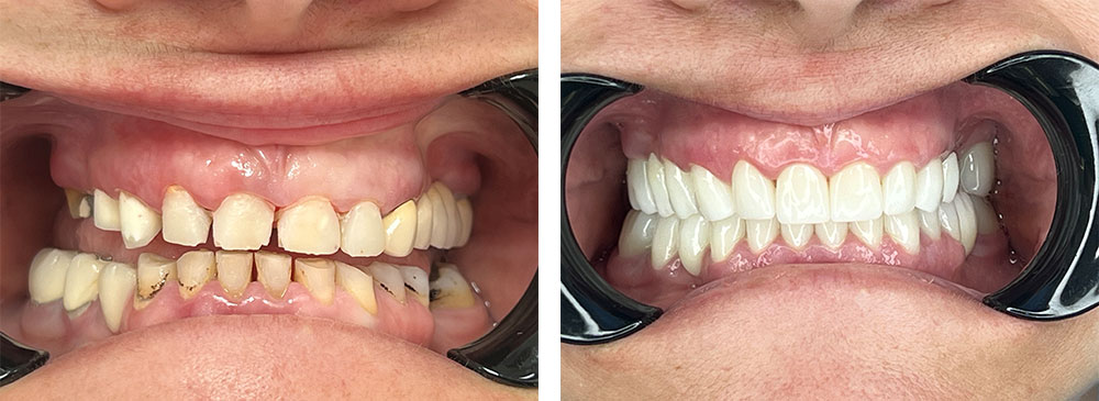 impianti dentali prima e dopo