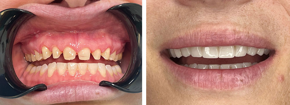 faccette dentali albania prima e dopo