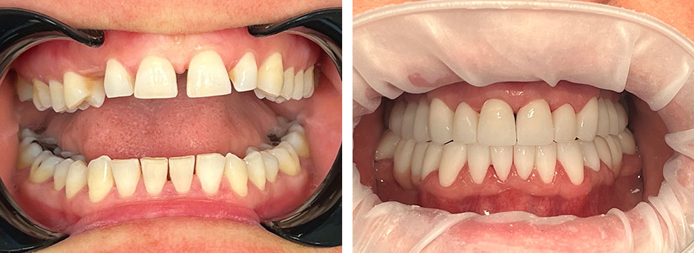 impianti dentali prima e dopo