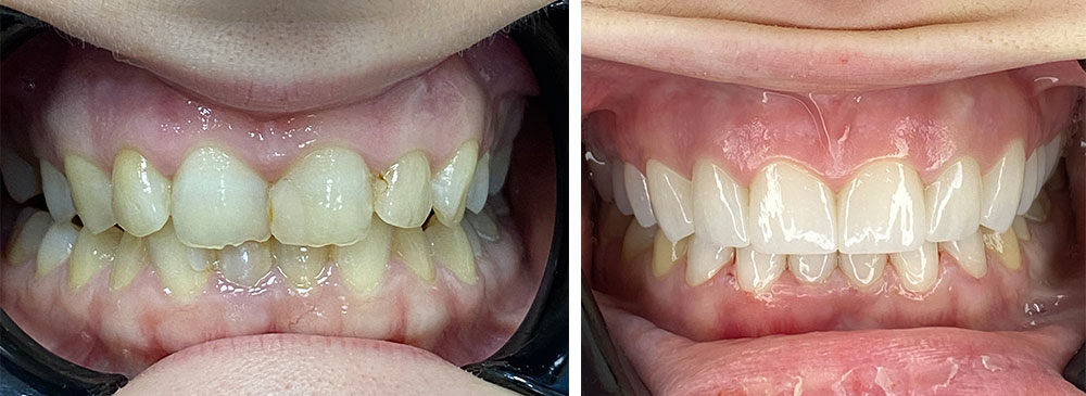 faccette dentali costo Albania