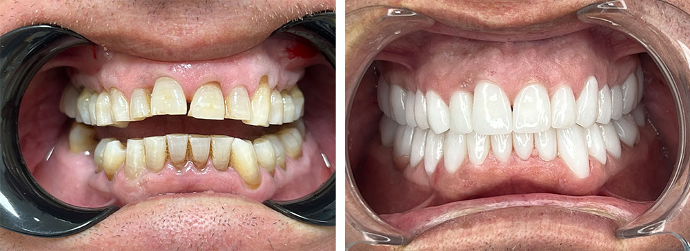 faccette dentali costo Albania