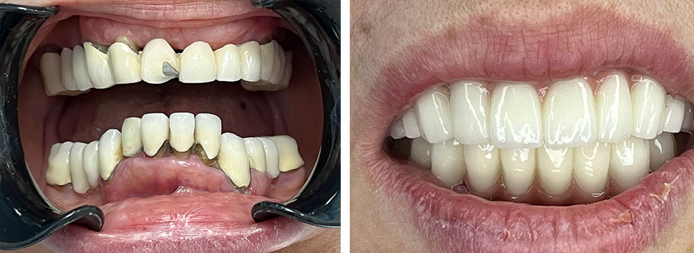 impianti dentali Albania Prima e Dopo