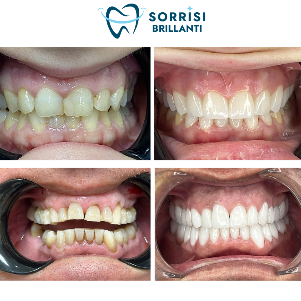 faccette dentali E-Max albania