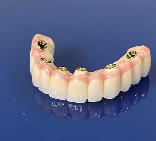 protesi e impianti dentali in albania