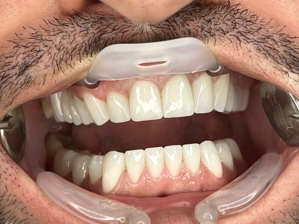 Fare i denti in albania prezzo conveniente