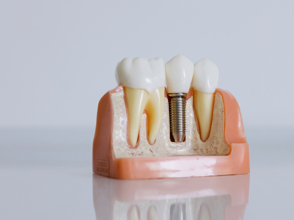 impianti dentali cosa sono