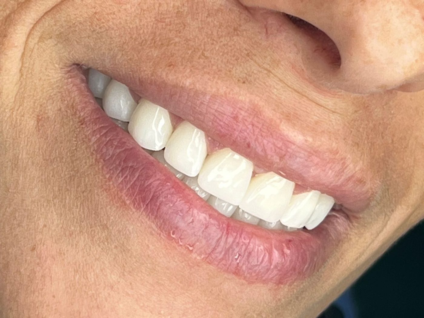 Rifarsi i Denti in Albania Perché Scegliere Sorrisi Brillanti