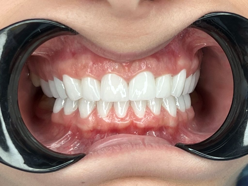 corona dentale in zirconio prezzo