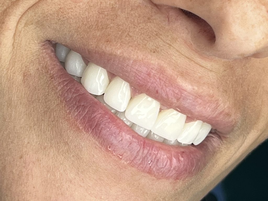 denti in zirconio, con corone di alta qualità