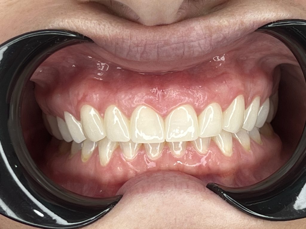 denti in zirconio, con corone di alta qualità
