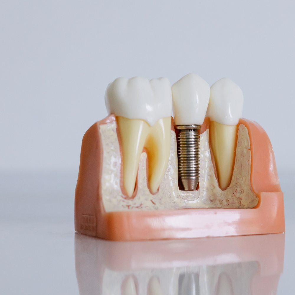 impianti dentali in albania sorrisi brillanti