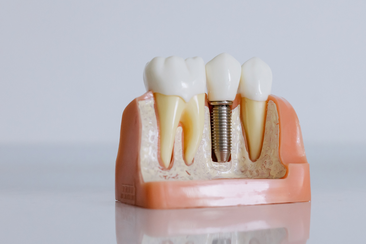 impianti dentali cosa sono