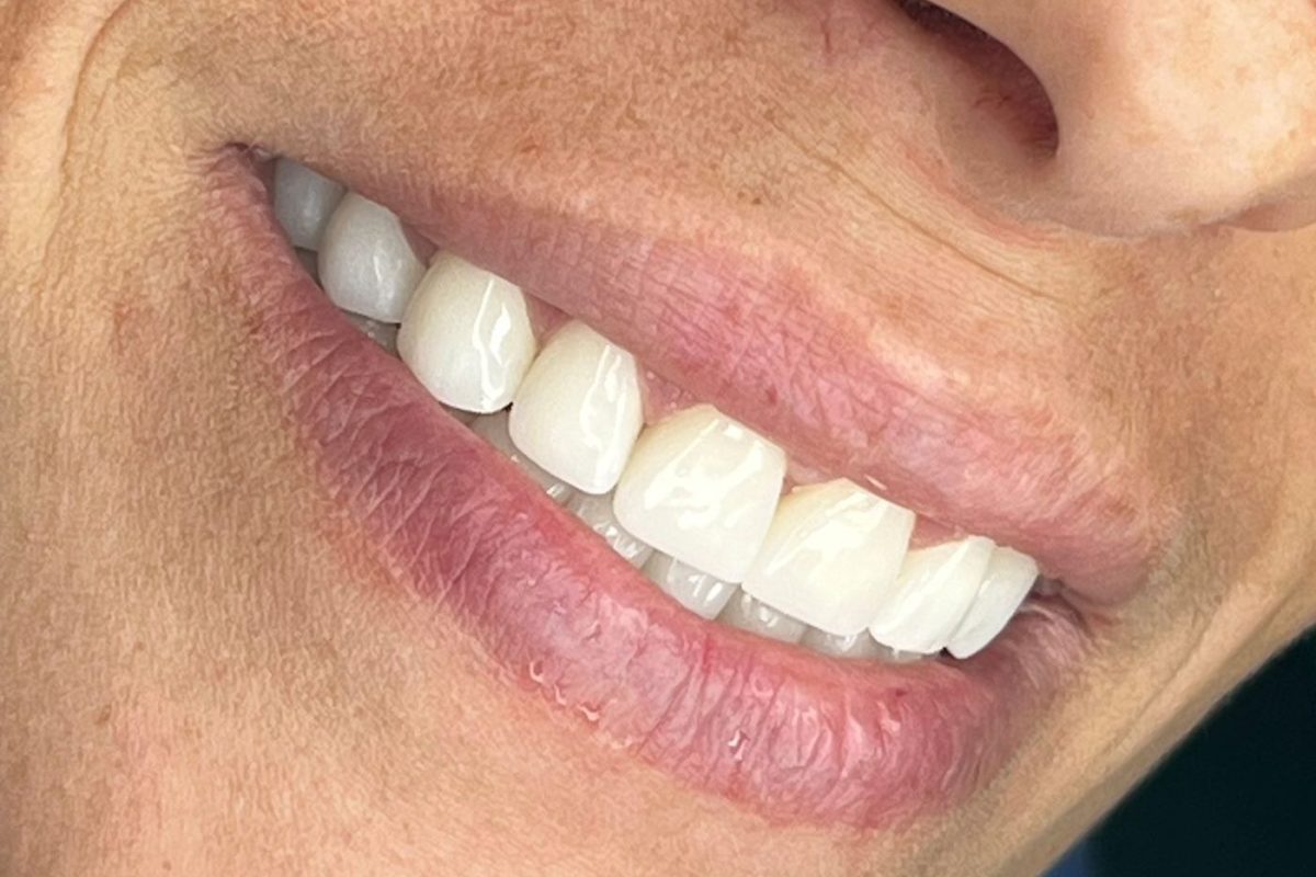 Rifarsi i Denti in Albania Perché Scegliere Sorrisi Brillanti