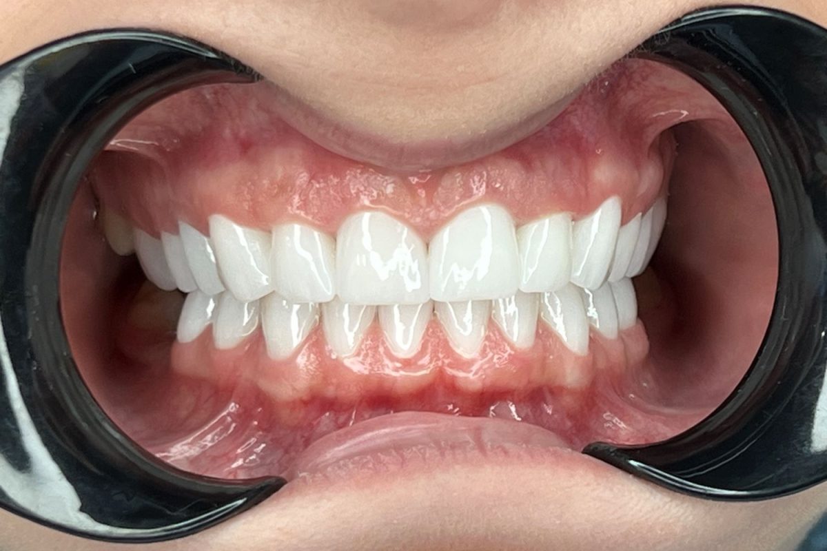 corona dentale in zirconio prezzo corona dentale in zirconio prezzo