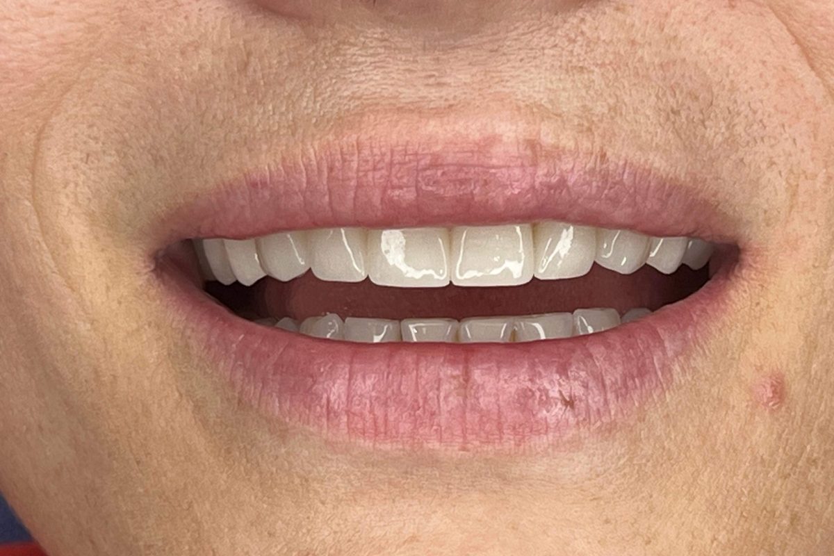 dopo (4) faccette dentali costo Albania