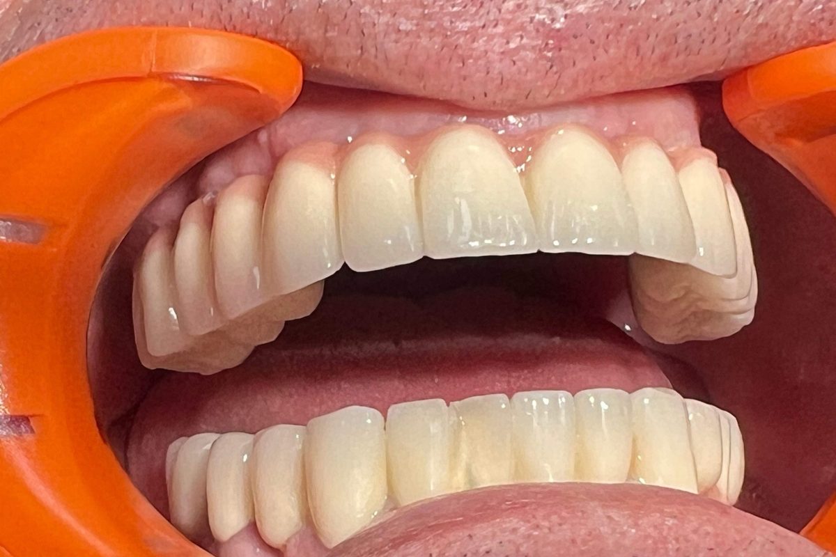 impianti dentali Albania