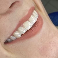 turismo dentale in albania