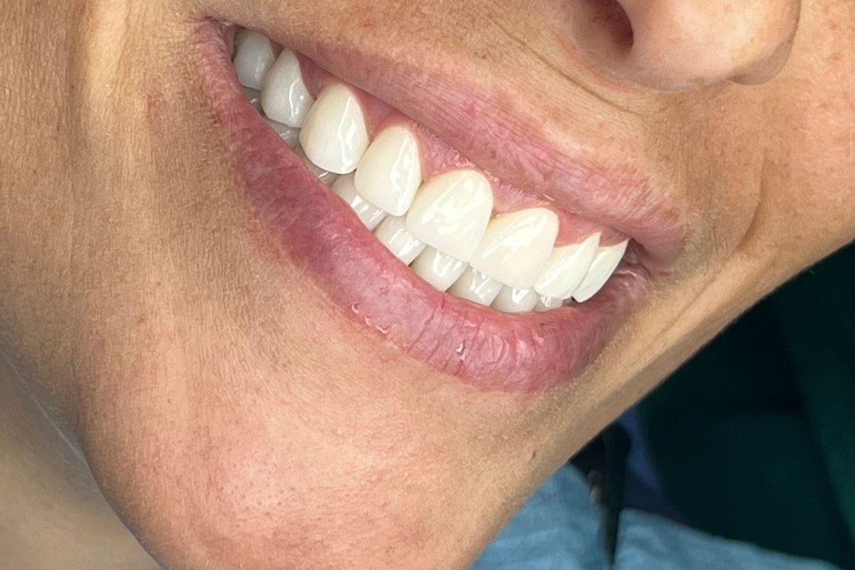 corone dentali in zirconio