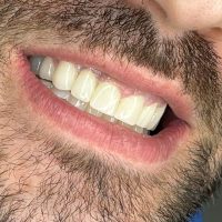 impianti-dentali-albania-prezzi-bassi