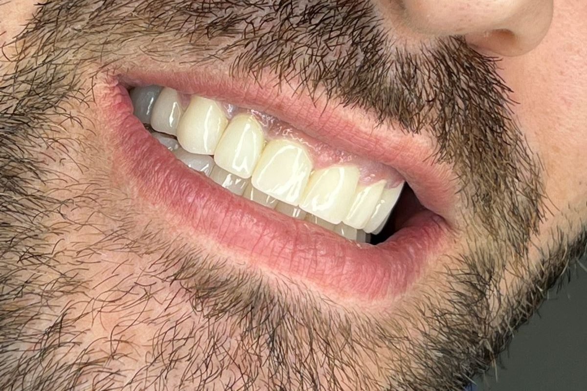 impianti dentali albania prezzi bassi impianti dentali in albania