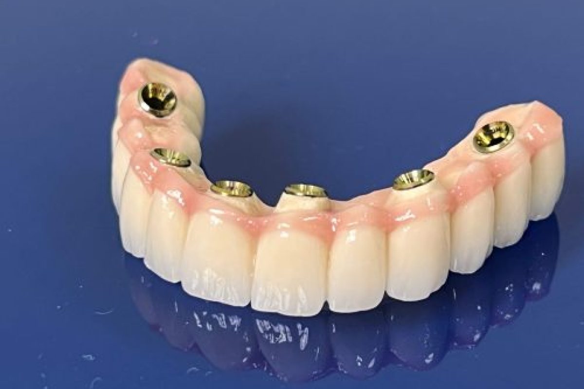 protesi dentale protesi e impianti dentali in albania