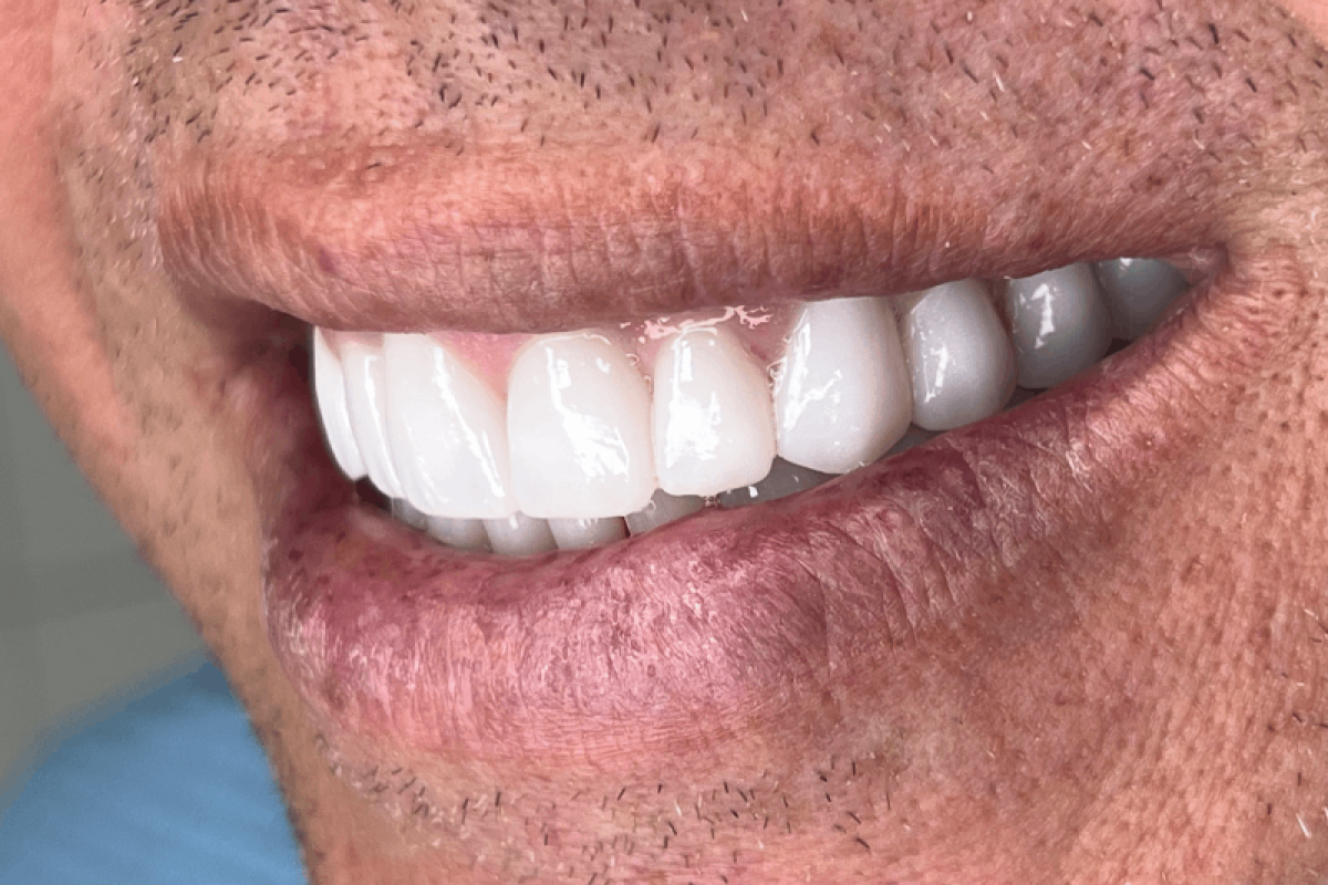 Turismo Dentale in Albania: Un Fenomeno in Crescita turismo dentale in albania