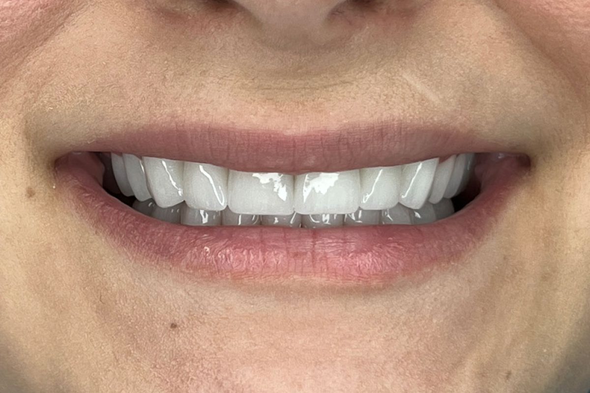 risultato-finale-1 Corona in Zirconia e Corona E-Max in Albania