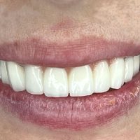 Corone Dentali in Albania: Zirconio e Ceramica